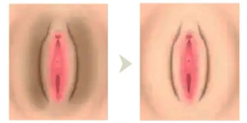 Genital Bölge Beyazlatma