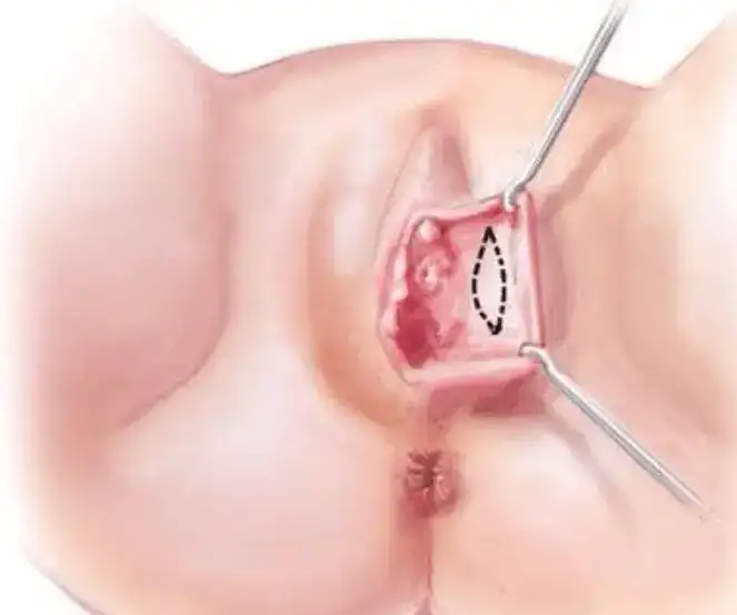 Labioplasti Teknikleri Derinleştirme Tekniği Deepithelialisation