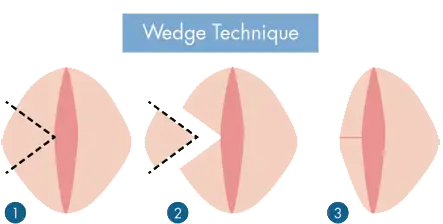 Labioplasti Teknikleri Kama Tekniği Wedge