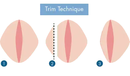 Labioplasti Teknikleri Kırpma Tekniği Trim